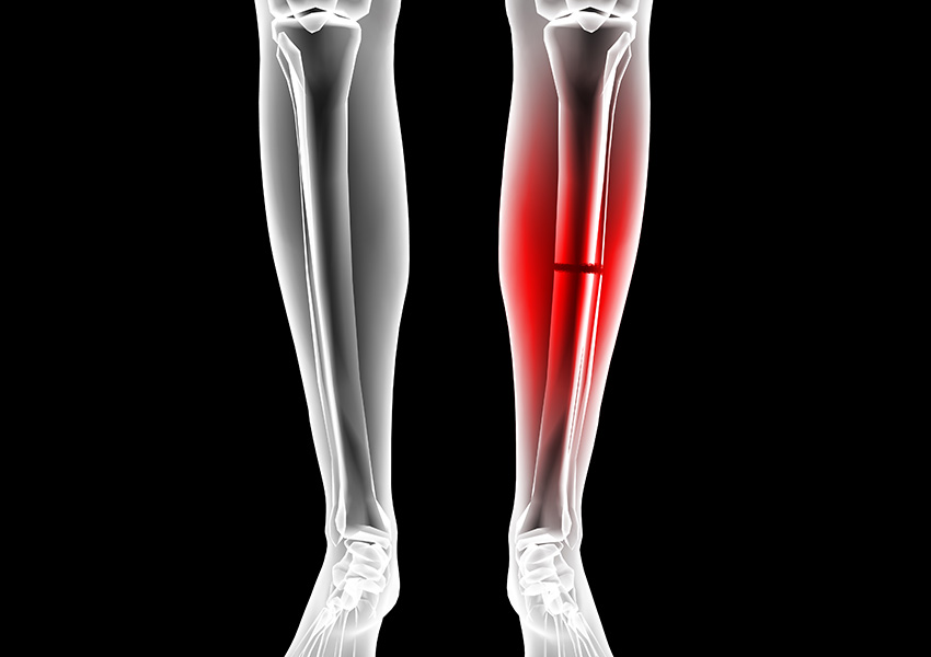 Broken leg image via Shutterstock 