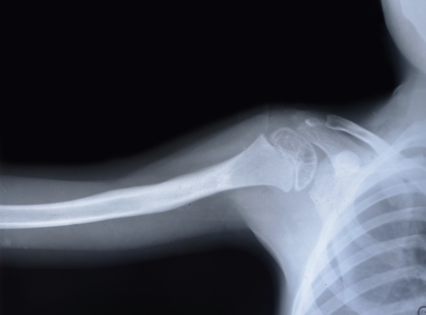 Bone image via Shutterstock.
