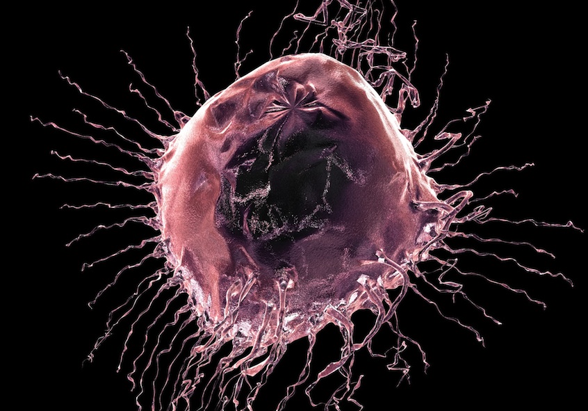 The aggressiveness of cancer cells, like the one above, may be affected by the ZEB1 gene. Breast cancer image via Shutterstock.