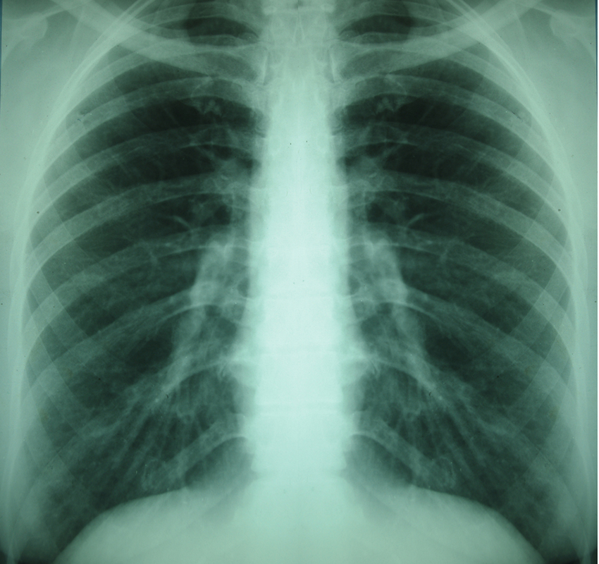 Lung X-ray image via shutterstock