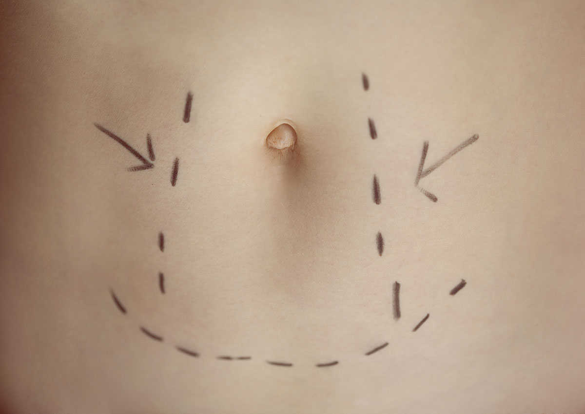 Marked for cosmetic surgery image via shutterstock