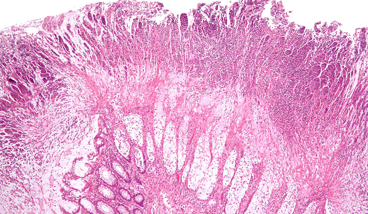 Clostridium difficile photo via wikimedia commons.