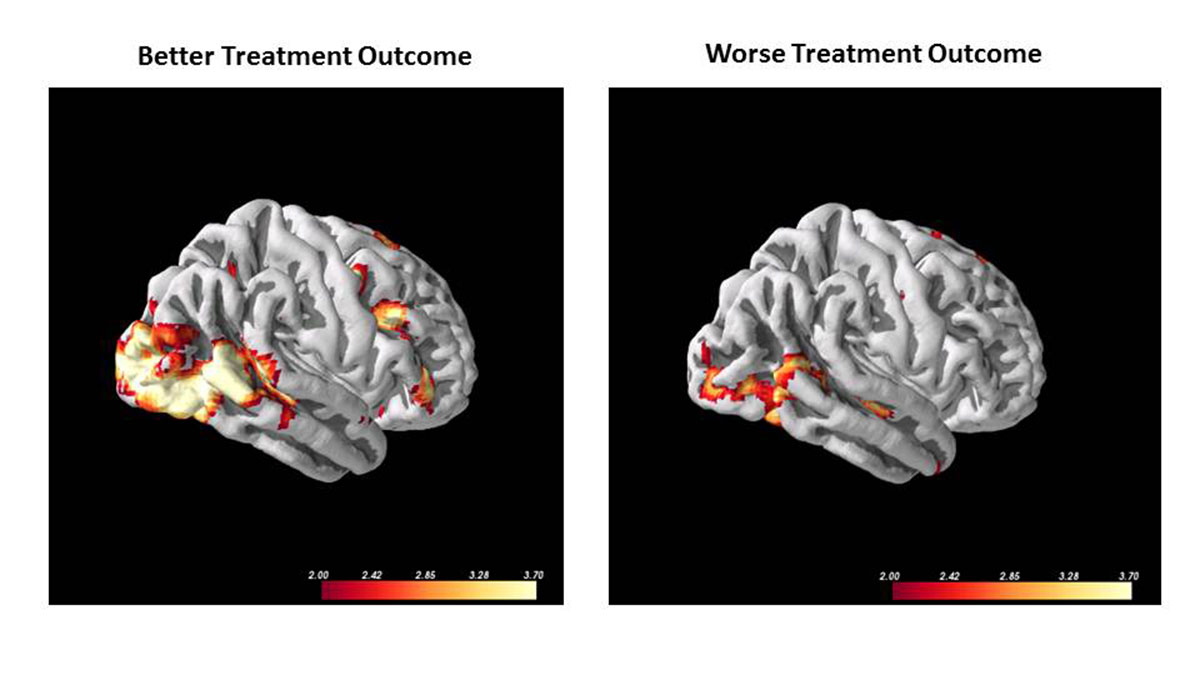 brain activation (fMRI) in patients BEFORE receiving cognitive behavioral therapy (CBT); the patients with greater activation on the left went on to have greater responses to the CBT treatment than the patients on the right  with lesser brain activation. Photo provided to bostonmagazine.com.