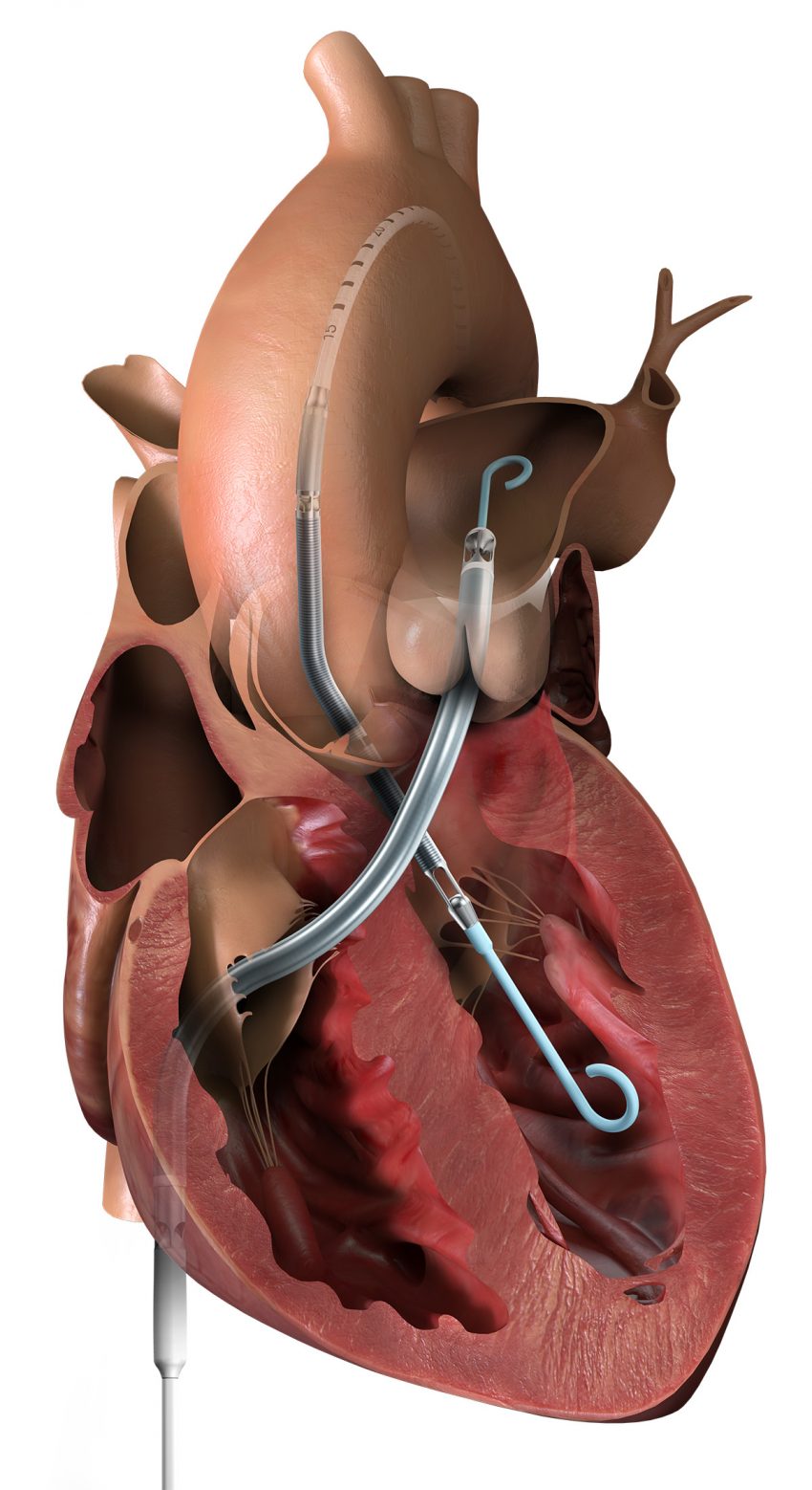 The Impella Is the World's Smallest Heart Pump