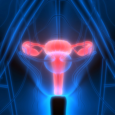 Personalized Screening Improves Early Detection of Deadly Ovarian ...