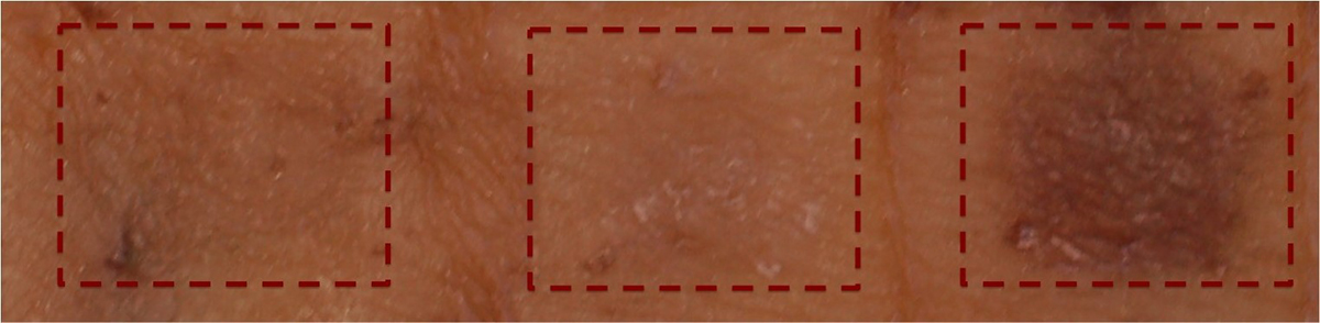 skin pigment