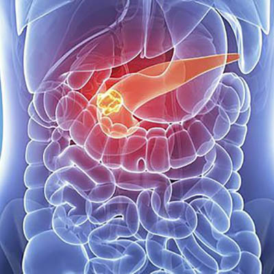 Targeting Pancreatic Cancer with a New Therapy - Boston Magazine