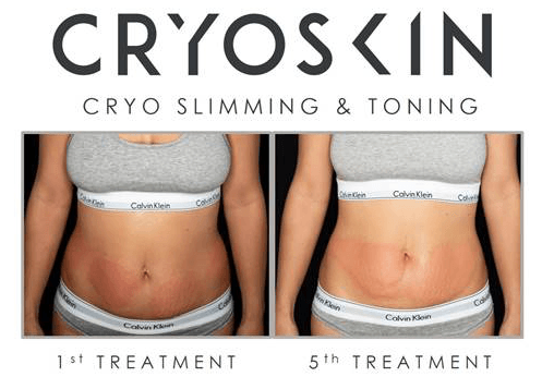 CryoSlimming Fat Reduction vs CoolSculpting: Which is Better for You?